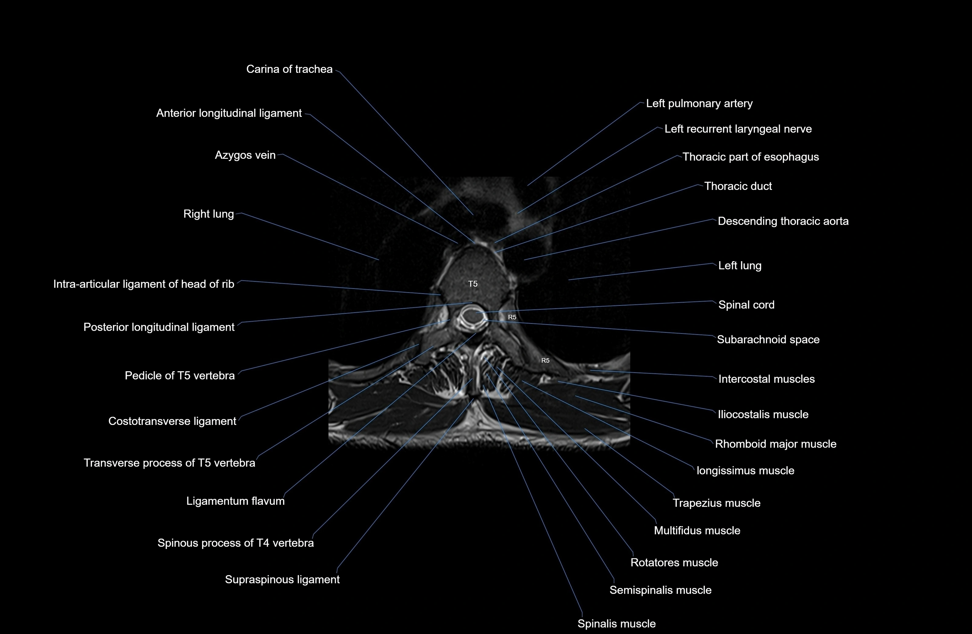 MRI thoracic spine axial  cross sectional anatomy 3T radiology  image-img-00001-00031.webp